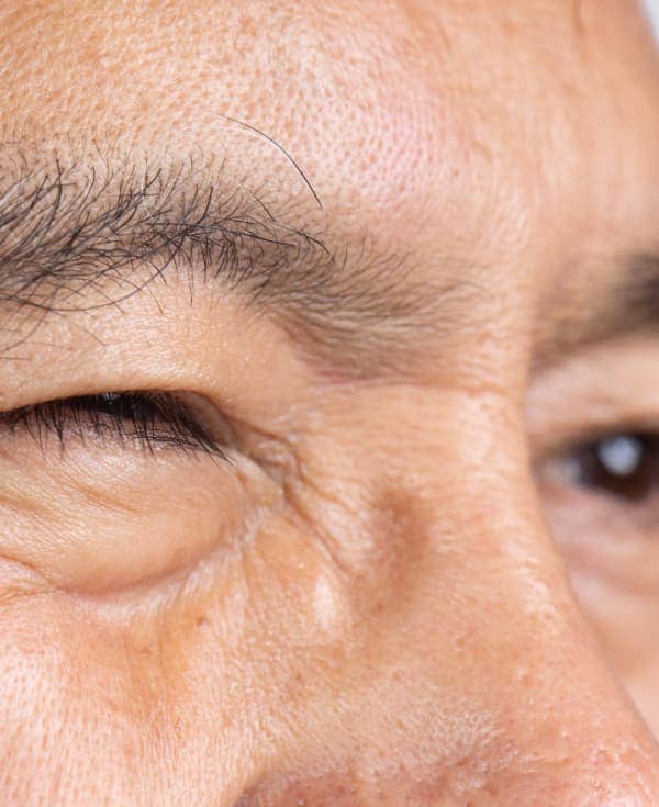 Un dolor que puede ser peor al abrir o cerrar los ojos